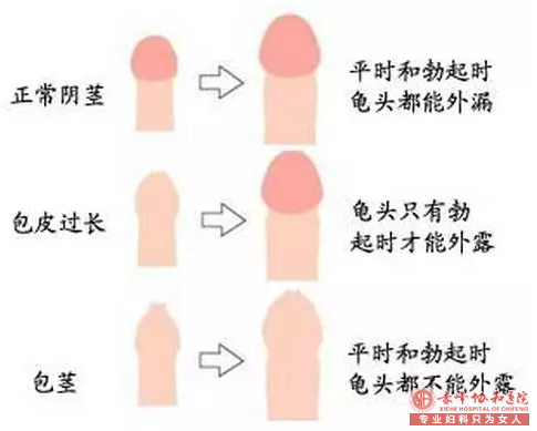 马鞍山是否割包皮！你的决定影响一生的性福...