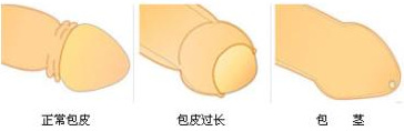 赤峰包皮包茎危害真的大吗?为何有人不割?
